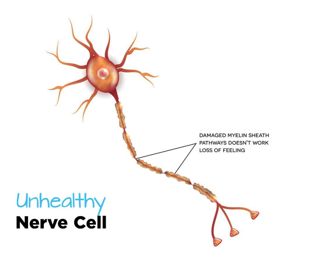 unhealthy-nerve-cell-infographic-1